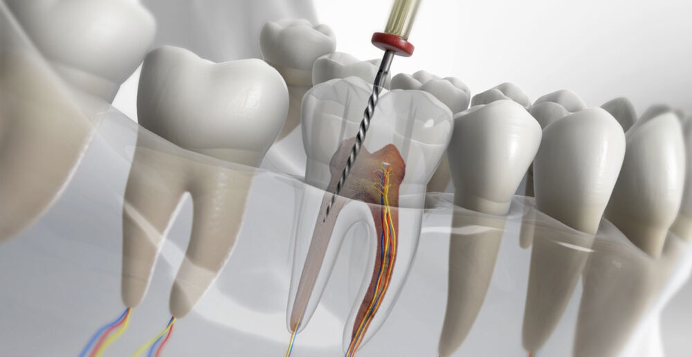 Πώς ένας ριζικός σωλήνας μπορεί να σώσει το δόντι σας