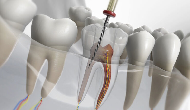 Πώς ένας ριζικός σωλήνας μπορεί να σώσει το δόντι σας